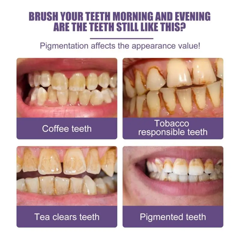 Oralhoe Teeth Cleaning Powder: Tartar & Stain Removal, Teeth Whitening - Image 3