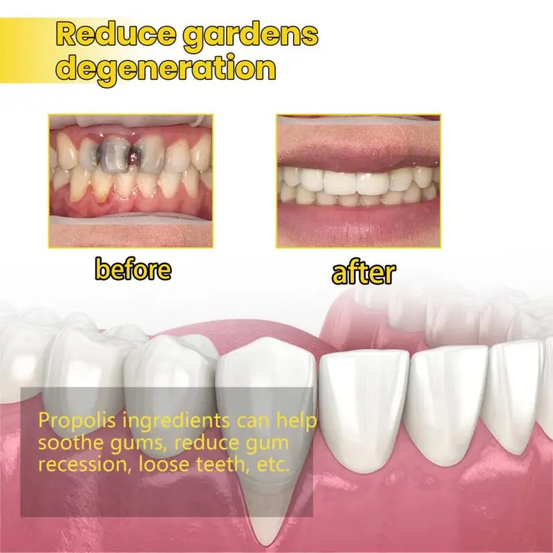 Oralhoe Propolis Gum Care Gel - Oral Care & Gum Health Gel - Image 3