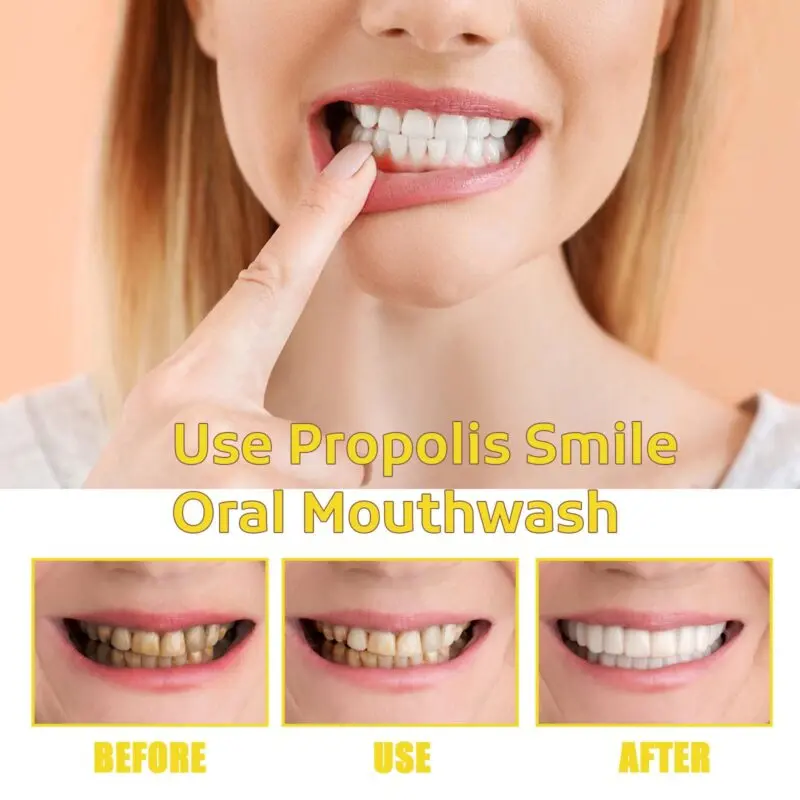 Oralhoe Propolis Oral Cleaning Mousse - Foaming Mouth Cleaner for Fresh Breath - Image 4