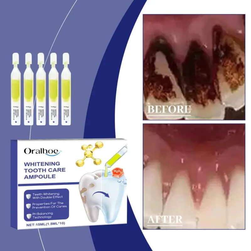Oralhoe Teeth Whitening Serum - Stain Removal, Yellowing Control & Oral Care - Image 2